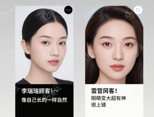 李瑞萱和雷蕾哪個雙眼皮做的好