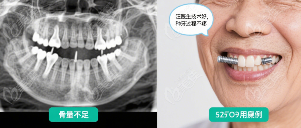 杭州团圆口腔詹传华医生：，种牙 “又快又稳”