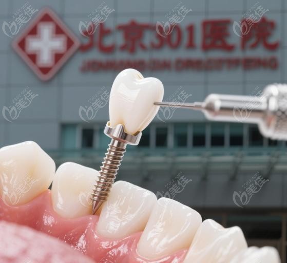 北京301医院种牙可靠吗