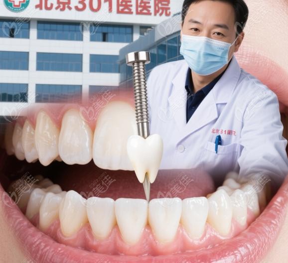 北京301医院种牙可靠吗？不同种植类型的适用性分析