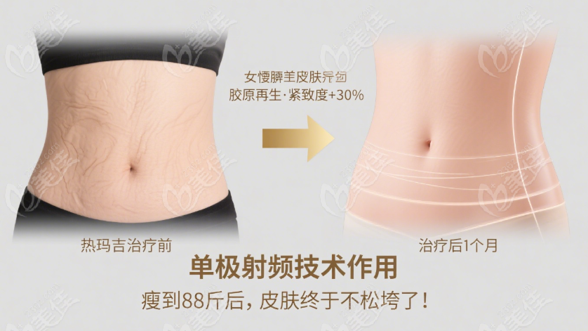 热玛吉治疗