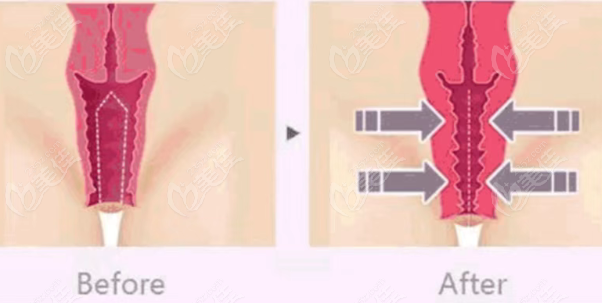 沈陽京科醫(yī)院私密緊縮術(shù)結(jié)果對決