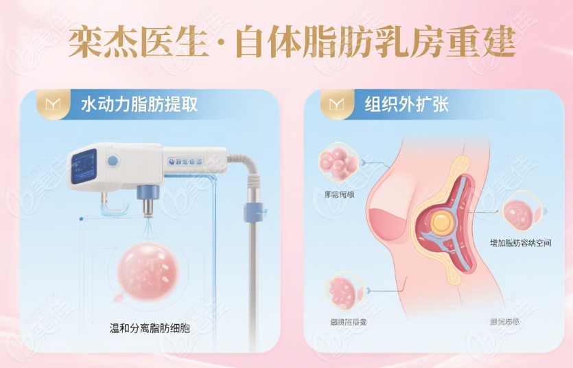 栾杰医生自体脂肪乳房重建