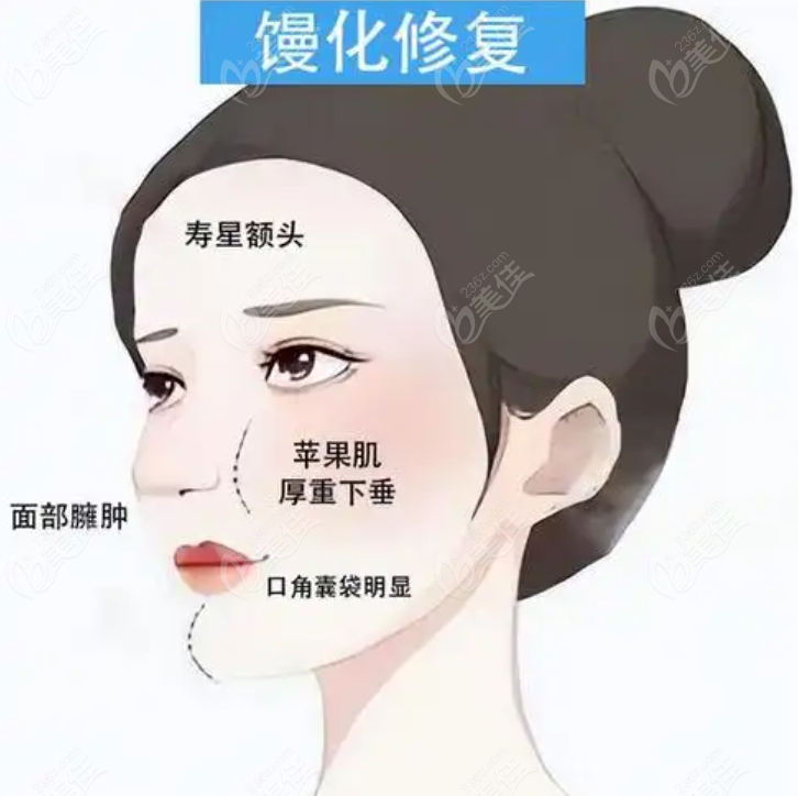 馒清术多少钱一次