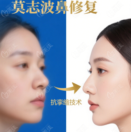 廣州莫志波鼻修復(fù)價(jià)格貴不貴