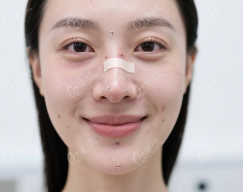 爱贝芙注射后鼻子会变宽吗