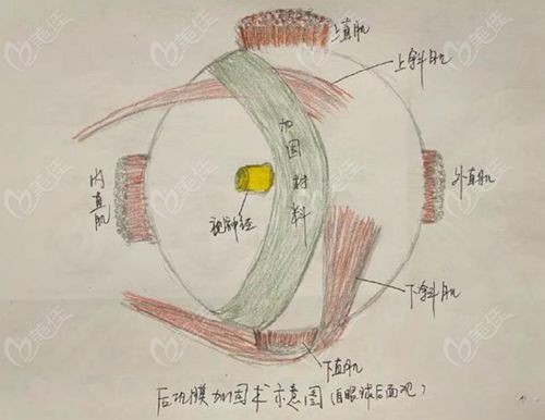 王乐今做了多少例后巩膜加固术啊