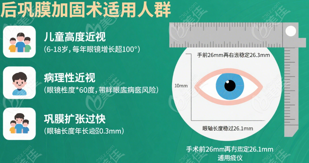 北京协和医院后巩膜加固术适合哪些人群