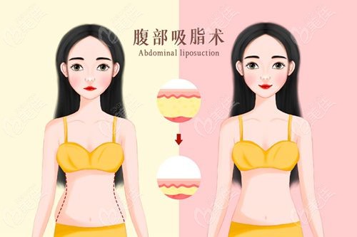 吸脂手术2.jpg