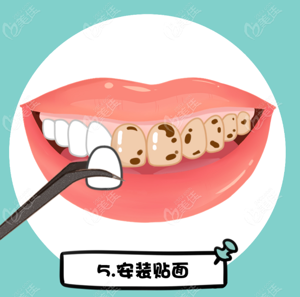 上海牙贴面医生排名