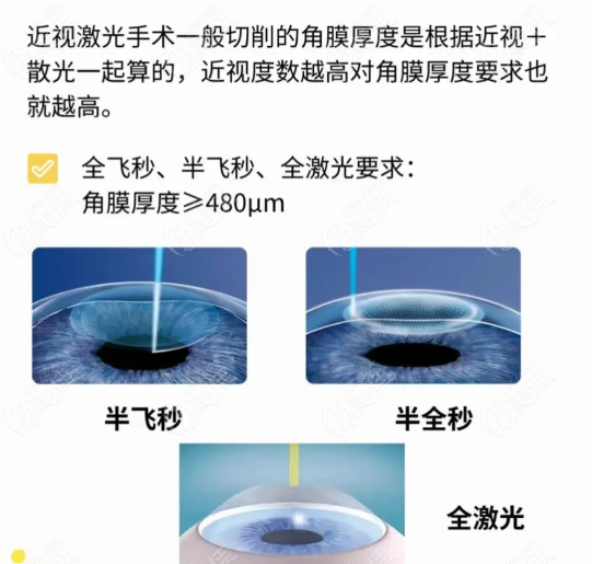 近视除了度数和角膜厚度，医生还会评估这些