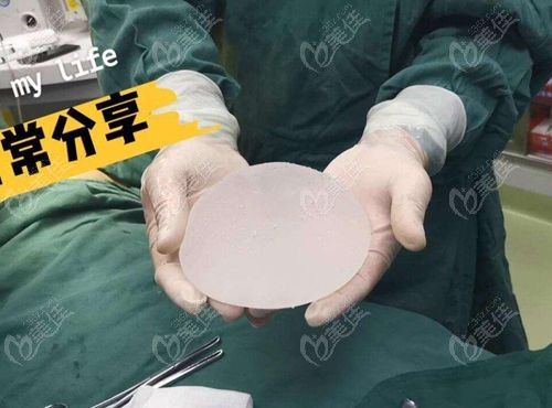 曼托假体隆胸250cc中凸成效
