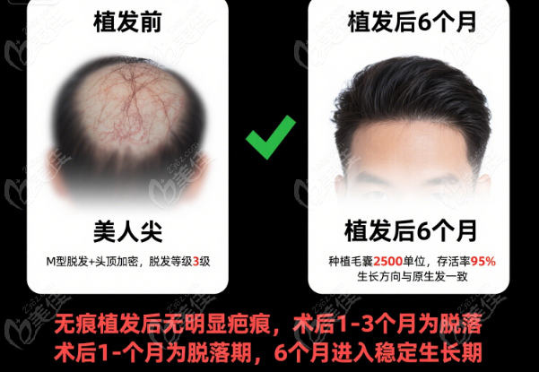 重庆植发医院怎么选