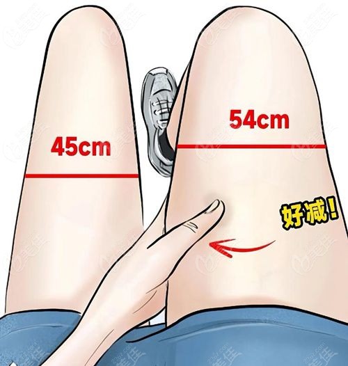 连云港大腿吸脂费用 1.5 万起