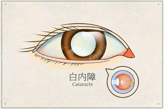 哪些人能申请沈阳爱尔眼科免费白内障手术