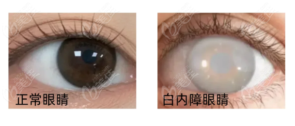 沈阳爱尔眼科免费白内障手术的常见疑问