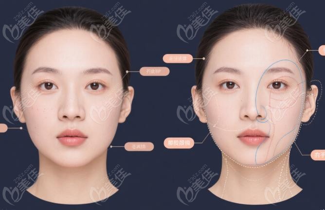 重庆肖林医生的颧骨内推手术实例：术前设计，成败关键