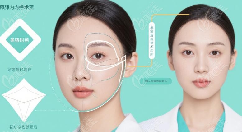 重庆肖林医生的颧骨内推手术实例：术后变好，科学管理