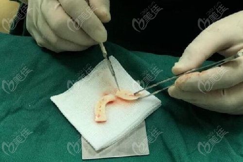 冯思阳隆鼻失败实例极少