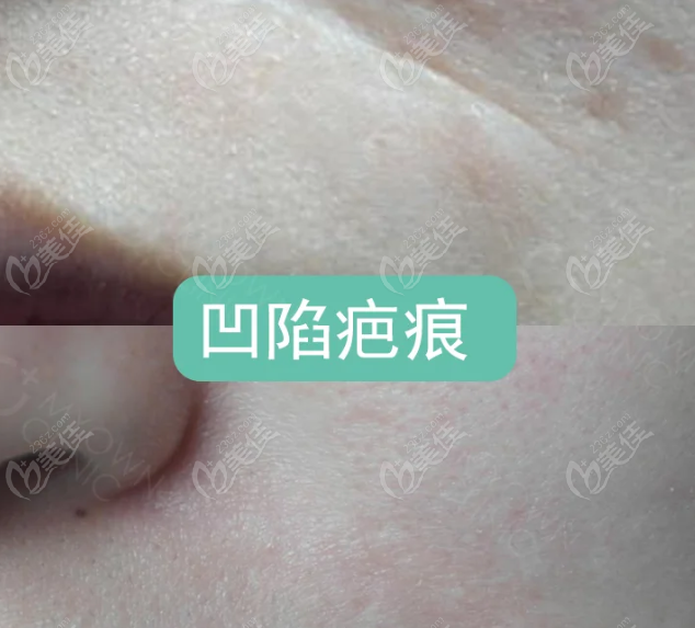 杨东运疤痕修复真人实例大公开