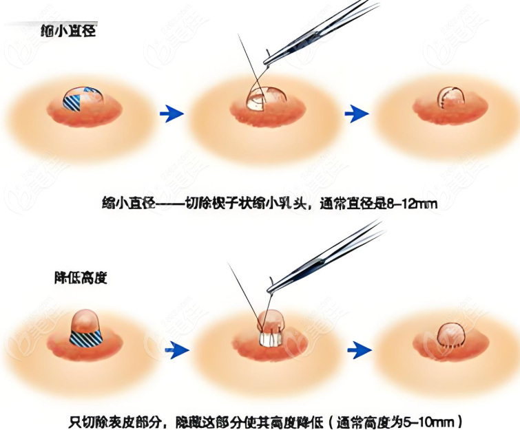 乳头整形手术www.236z.com