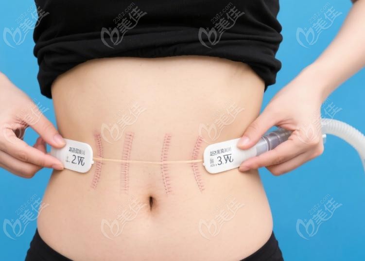 赵军舰腰腹四件套术后成效如何