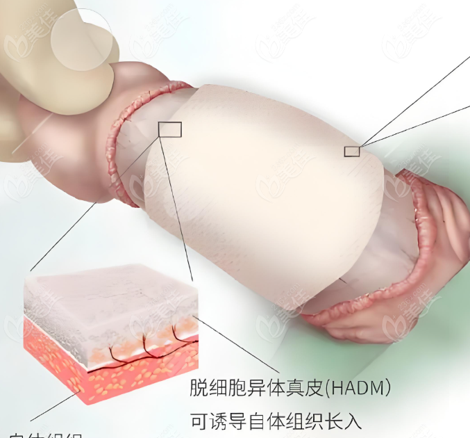 李世荣手术实例的手术费大概多少钱