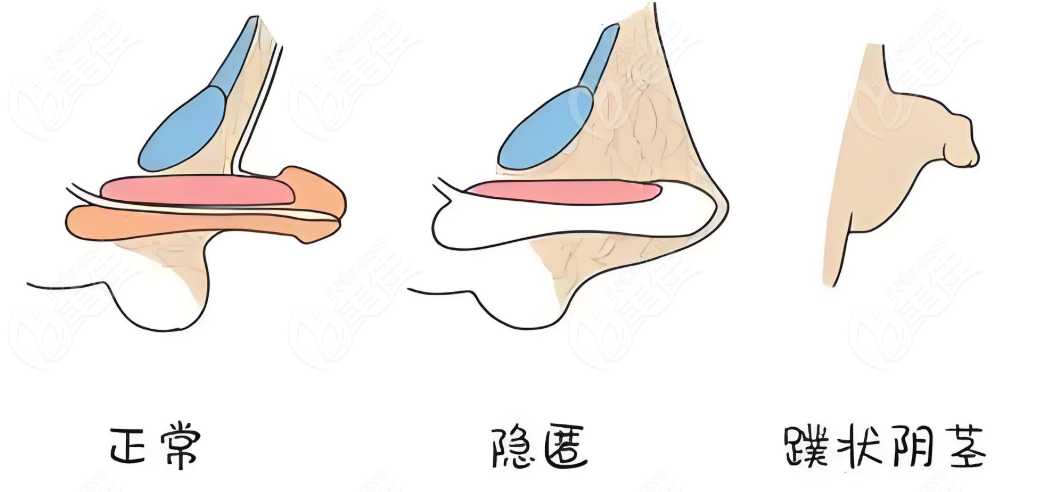 不同阴茎情况