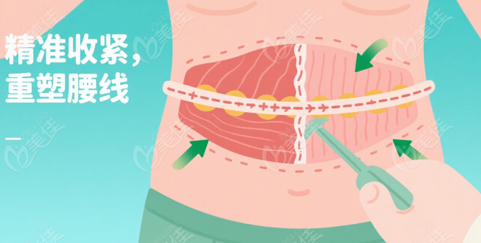 腹壁成型技术：收紧小腹，原理看这里