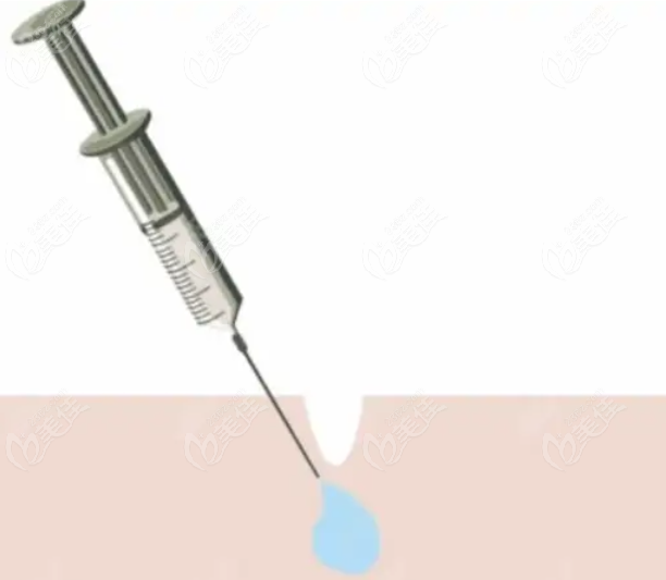 进口材料做私密整形会贵很多吗？