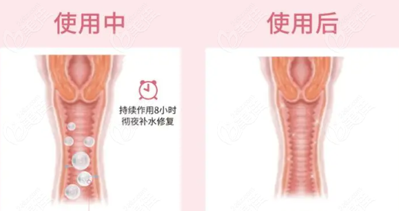 瑞蓝丽瑅vs润百颜玻尿酸注射阴道紧缩价格PK