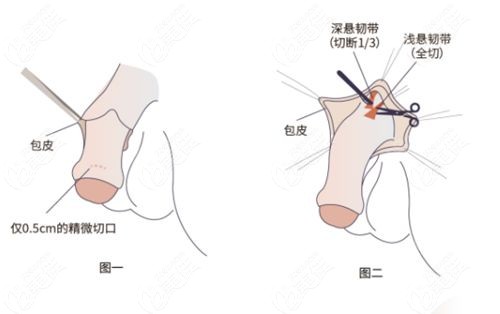 男性生殖整形医生吕巍真实范例