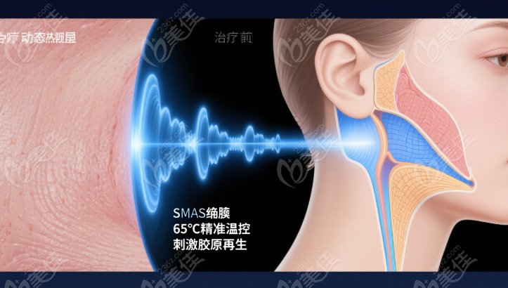 西安画美医院超声炮的疗效