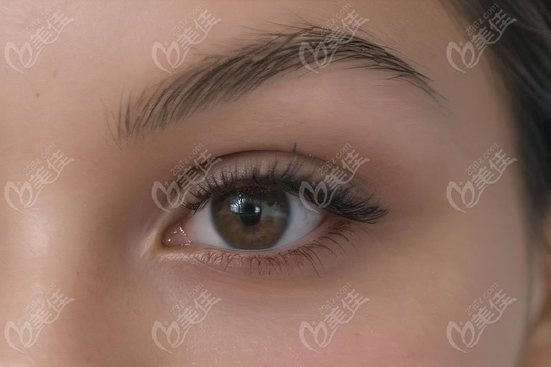 褚仁遠后鞏膜微創(chuàng)手術(shù)費用公開：微創(chuàng)技術(shù)加持費用還不貴