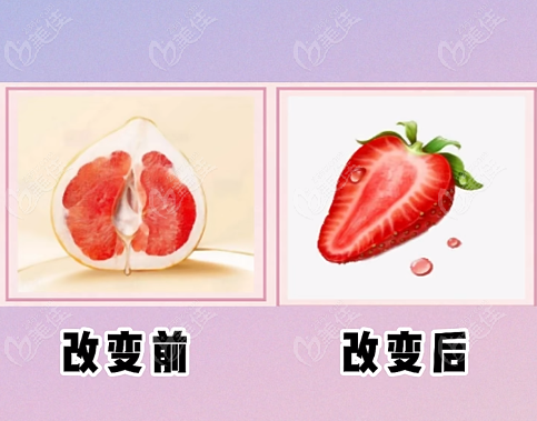 菲蜜麗陰道緊縮術(shù)的優(yōu)勢