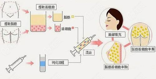 北京藝美整形王東修復(fù)脂肪費用詳情