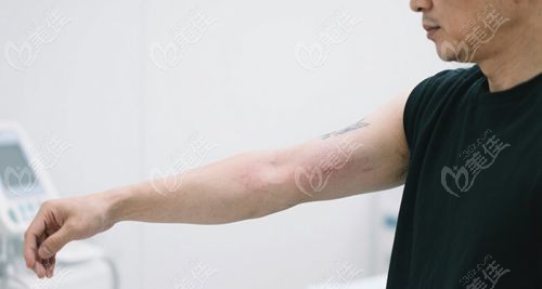 徐州洗紋身真實整友反饋