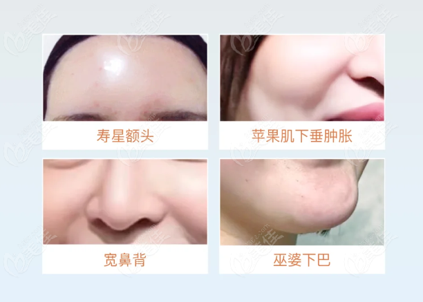 如何让清秀针有用武之地，避免“馒化”或白花钱