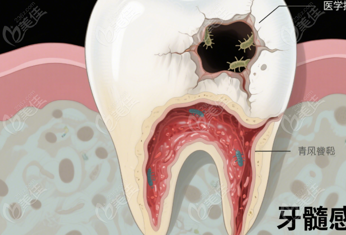 前磨牙根管治療