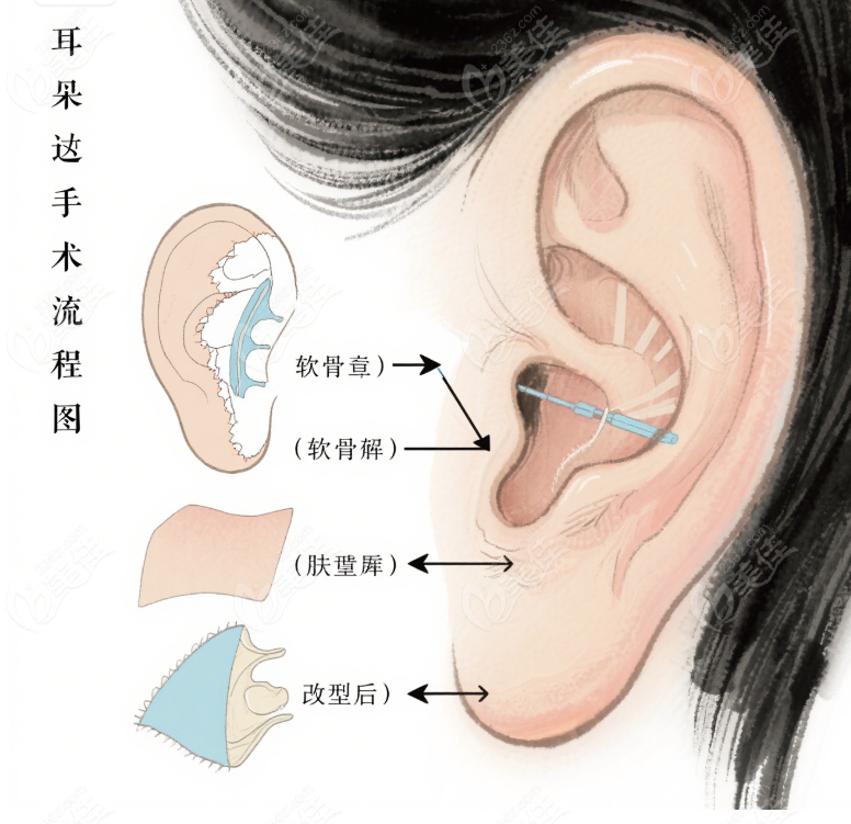耳整形手术