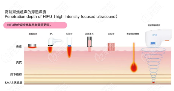 超聲炮面部提拉30天面部提拉緊致變化日記