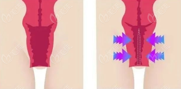 做了3D生物束带紧缩术术后护理决定手术