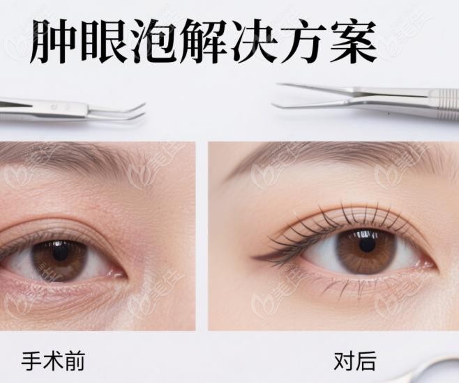 初眼“困难户”福音：张颖的靶心就是你的“肿、垂、包”
