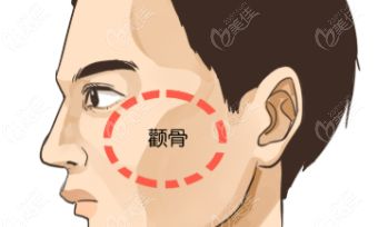 顴骨內(nèi)推