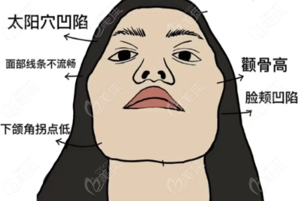 顴骨內(nèi)推