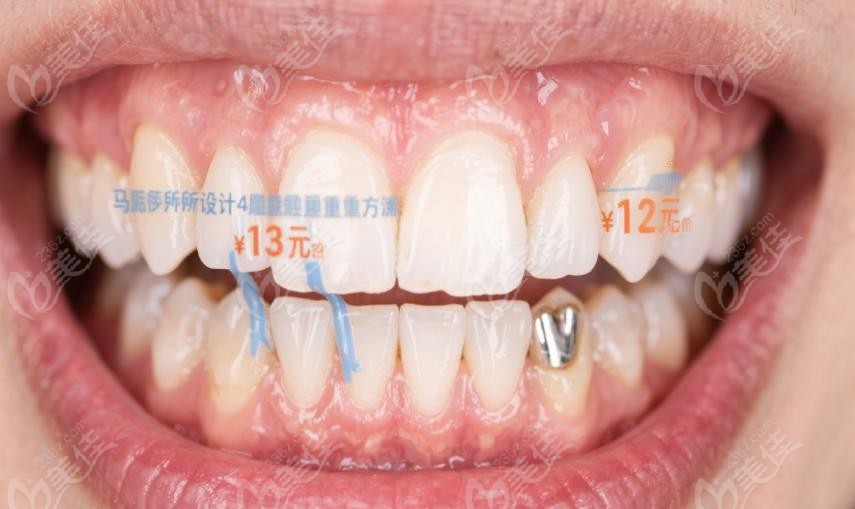 阿姨的"牙"生困境：全口缺失+骨萎缩，连饭都吃不香