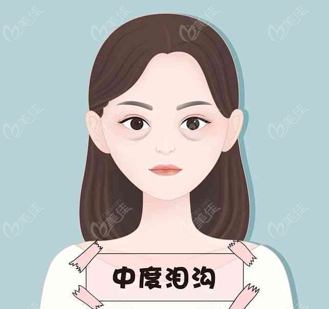 大連沙醫(yī)生解析淚溝成因與解決方案