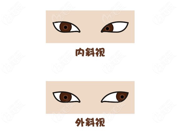 眼科医生李晓林斜视矫正技术稳