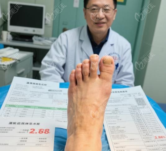 温建民拇外翻手术的真实反馈与疗效表现