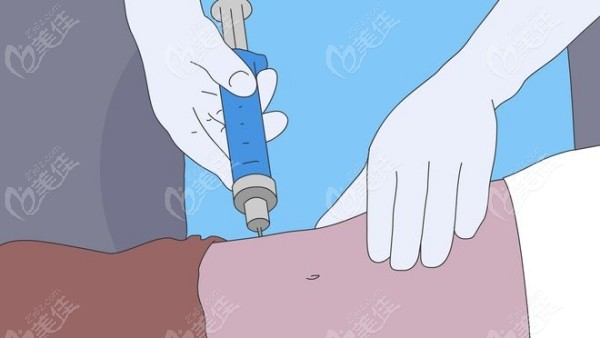 许扬滨脂肪隆胸